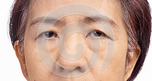 The ptosis or droopy eyelids in asian senior woman
