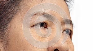 The ptosis or droopy eyelids in asian senior woman