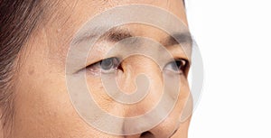 The ptosis or droopy eyelids in asian senior woman