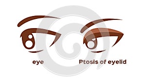 Ptosis of eyelid . eye sickness anatomy vector