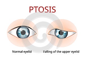 Ptosis of eyelid, eye sickness anatomy, eye sickness anatomy, vector photo