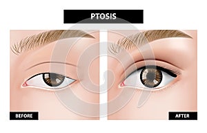 Ptosis of eyelid