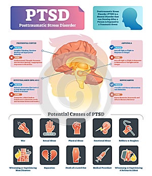 PTSD vector illustration. Labeled anatomical mental disorder causes scheme. photo