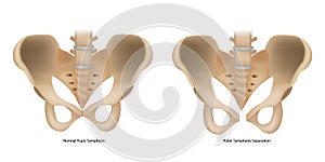 Pubic Symphysis Separation or SPD. Symphysis Pubis Dysfunction and Normal Pupic Symphysis. photo