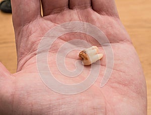 Pulled out old wisdom tooth