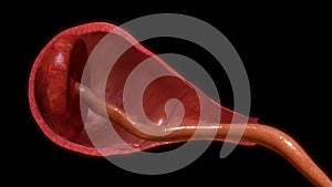 Pulling placenta out of uterus