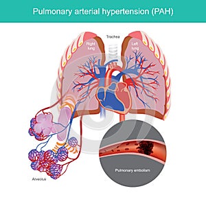 Pulmonary arterial hypertension.