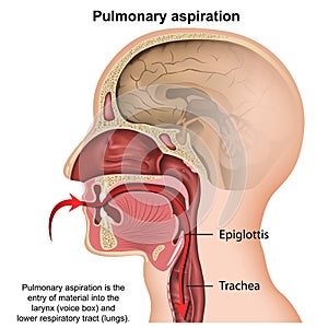 Pulmonary aspiration medical vector illustration isolated on white background