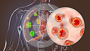Pulmonary blastomycosis, 3D illustration photo