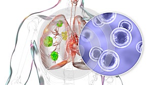 Pulmonary blastomycosis, 3D illustration photo