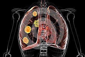 Pulmonary blastomycosis, 3D illustration photo