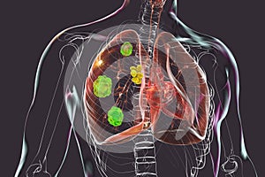 Pulmonary blastomycosis, 3D illustration photo