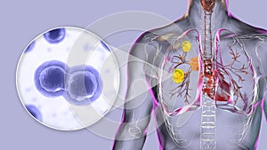 Pulmonary blastomycosis, 3D illustration photo