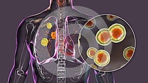 Pulmonary blastomycosis, 3D illustration photo
