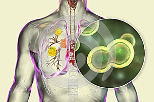 Pulmonary blastomycosis, 3D illustration photo