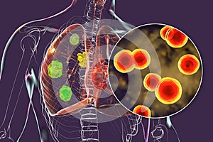 Pulmonary blastomycosis, 3D illustration photo
