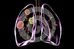 Pulmonary blastomycosis, 3D illustration photo