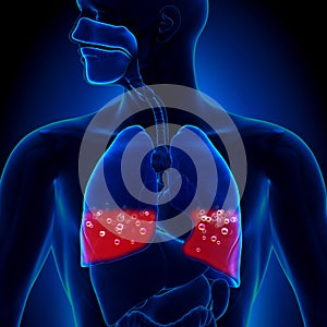 Pulmonary Edema - Blood in Lungs photo