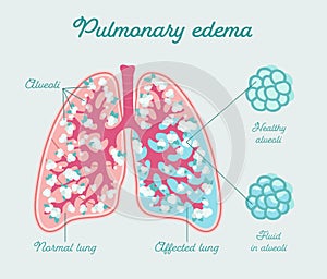 Pulmonary edema, edema of lung. Fluid in alveoli - vector anatomical scheme. Comparison healthy and fill of liquid lungs