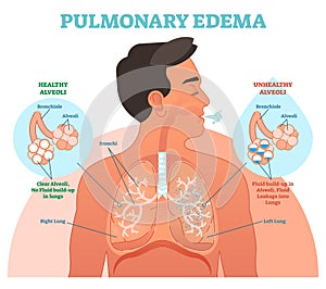 Pulmonary edema, lung problem vector illustration diagram