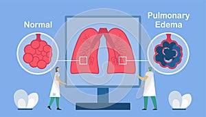 Pulmonary edema is shown good and bad alveoli. Other names is lung congestion, lung water, and pulmonary congestion. à¸ºBody