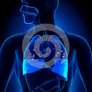 Pulmonary Edema - Water in Lungs