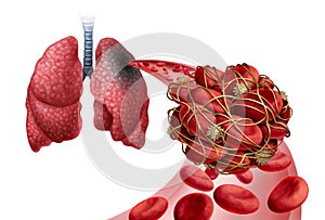 Pulmonary Embolism