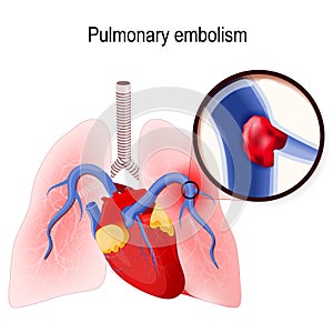 Pulmonary embolism. Human lungs and heart.