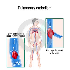 Pulmonary embolism. Human silhouette with highlighted circulatory system. photo