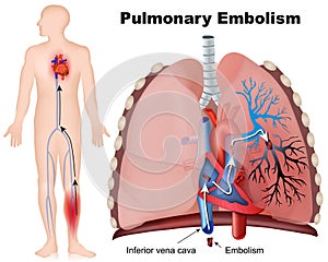 Pulmonary  embolism medical  illustration with description on white background