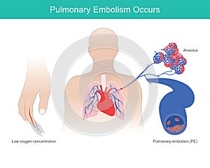 Pulmonary Embolism Occurs. photo