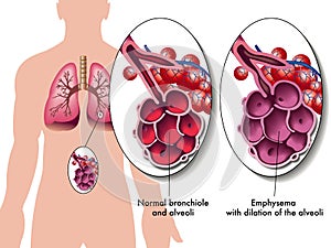 Pulmonar dificultad para respirar 