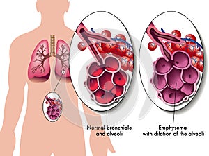 Pulmonary emphysema