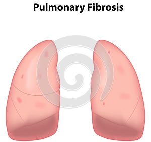 Pulmonary Fibrosis Lungs
