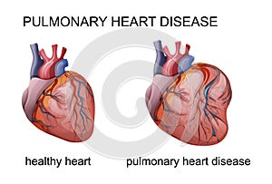 Pulmonary heart disease