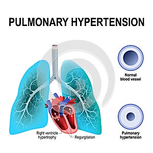 Pulmonary hypertension photo