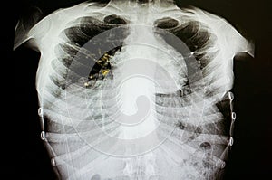 pulmonary tuberculosis