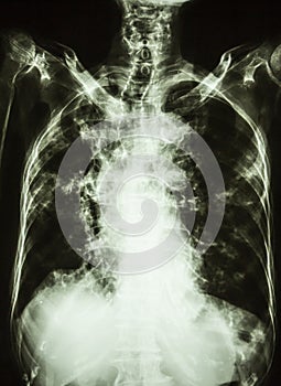 Pulmonary tuberculosis