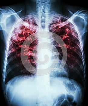 Pulmonary tuberculosis