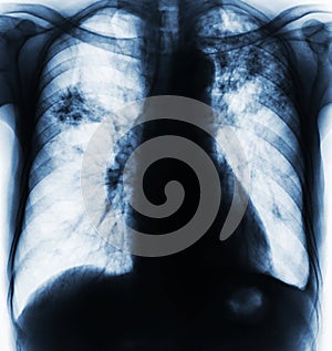 Pulmonary Tuberculosis .