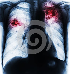 Pulmonary Tuberculosis .