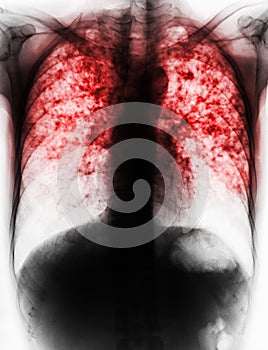 Pulmonary Tuberculosis .