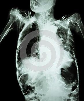 Pulmonary Tuberculosis with acute respiratory failure ( Film chest x-ray of old patient show alveolar and interstitial infiltratio