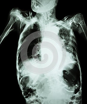 Pulmonary Tuberculosis with acute respiratory failure ( Film chest x-ray of old patient show alveolar and interstitial infiltratio photo