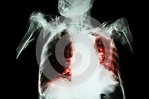 Pulmonary Tuberculosis with acute respiratory failure ( Film chest x-ray of old patient show alveolar and interstitial infiltratio photo