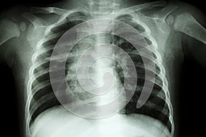 Pulmonary Tuberculosis ( Chest X-ray of child : show patchy infiltration at right middle lung )