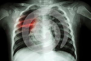 Pulmonary Tuberculosis ( Chest X-ray of child : show patchy infiltration at right middle lung )