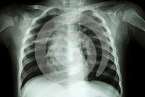 Pulmonary Tuberculosis ( Chest X-ray of child : show patchy infiltration at right middle lung ) photo