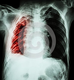 Pulmonary Tuberculosis . Chest X-Ray : Right lung atelectasis and infiltration and effusion due to Mycobacterium Tuberculosis i photo