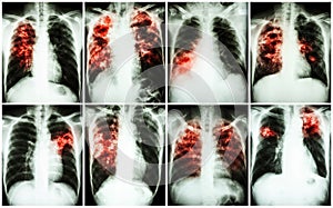Pulmonary Tuberculosis Collection . Chest X-ray : show patchy infiltration , interstitial infiltration , alveolar infiltration ,